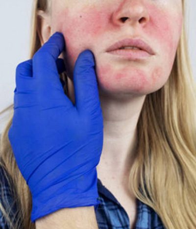 Piel de rostro con rosácea antes de tratamiento láser vascular